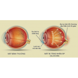 BỆNH GLÔCÔM