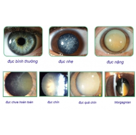 Đục thủy tinh thể là gì?