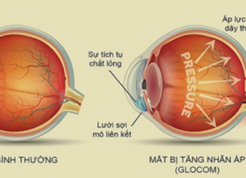 BỆNH GLÔCÔM