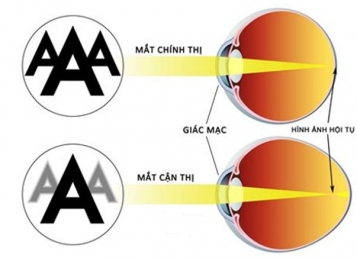 Khám và điều trị các tật khúc xạ