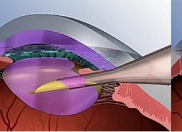 Phẫu thuật phaco
